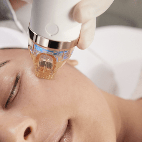 Secret RF ( Face) at Michelin Beauty Studio in Brooklyn, NY